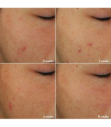 ست محصولات بلمیش ایج دیفای نوایج پلاس